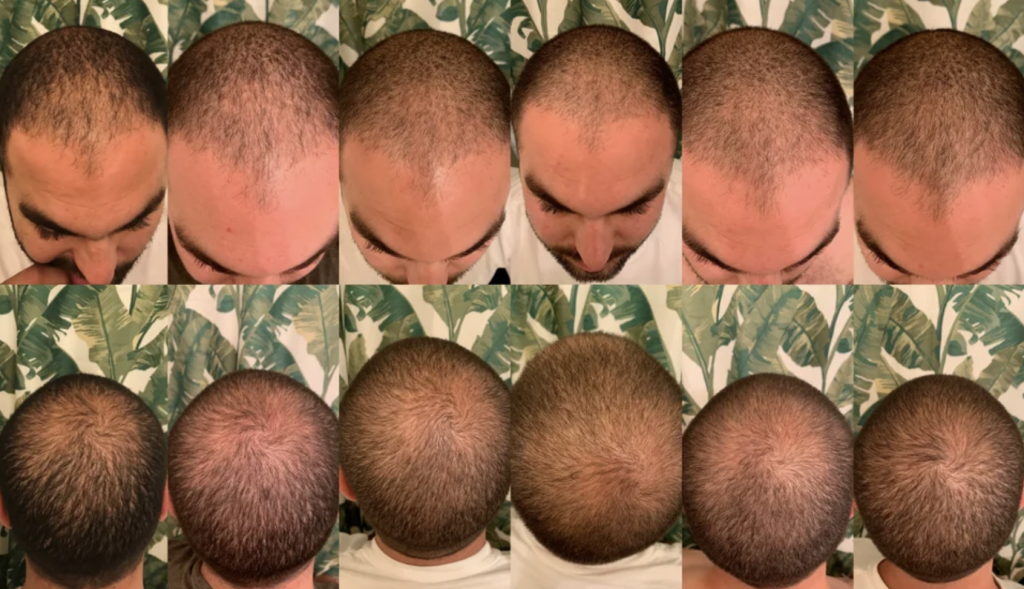 three-months-on-finasteride-minoxidil-and-microneedling-from-reddit