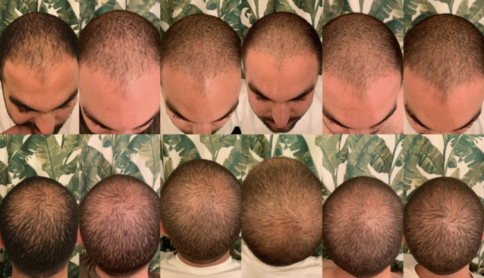 Three months on finasteride, minoxidil and microneedling (from Reddit) .