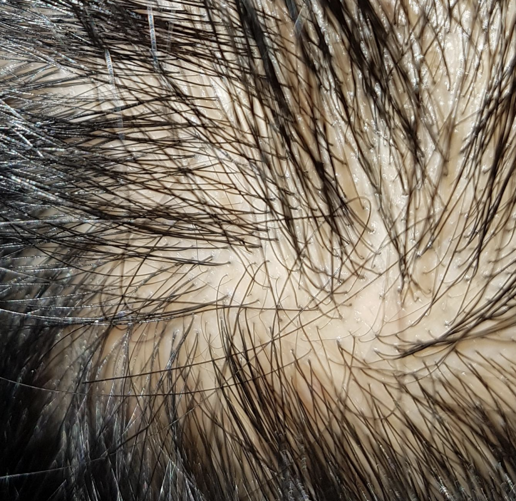 My Scalp is Thinning. I’m 24. What Do You Think of It? – WRassman,M.D ...