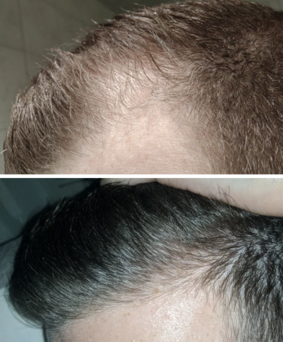 can finasteride make hair loss worse reddit