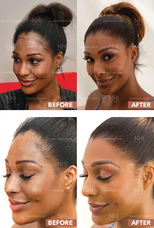 Hairline lowering hair transplant in African American Woman (photo) –  WRassman,. BaldingBlog