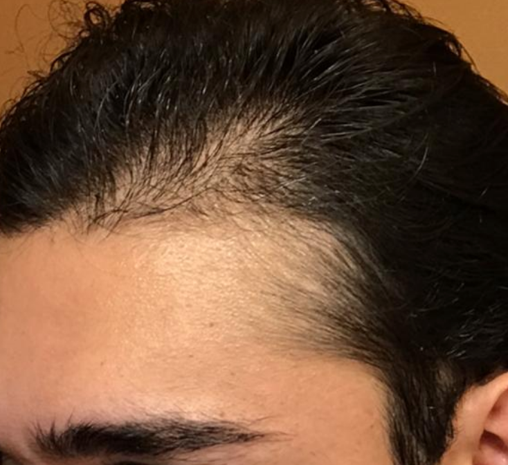 Im 21 And Have Been Using Minoxidil For 2 Months Wrassmanmd