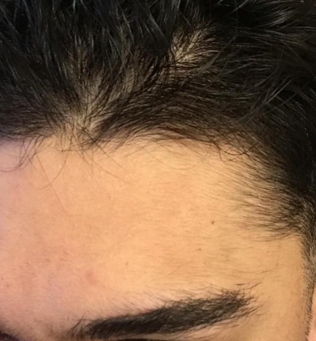 I’m 21 and have been using minoxidil for 2 months – WRassman,M.D ...