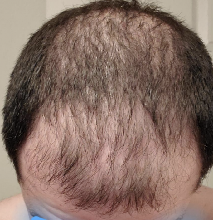 3 years with Finasteride, Minoxidil, Nizoral and a Dermapen (photos ...