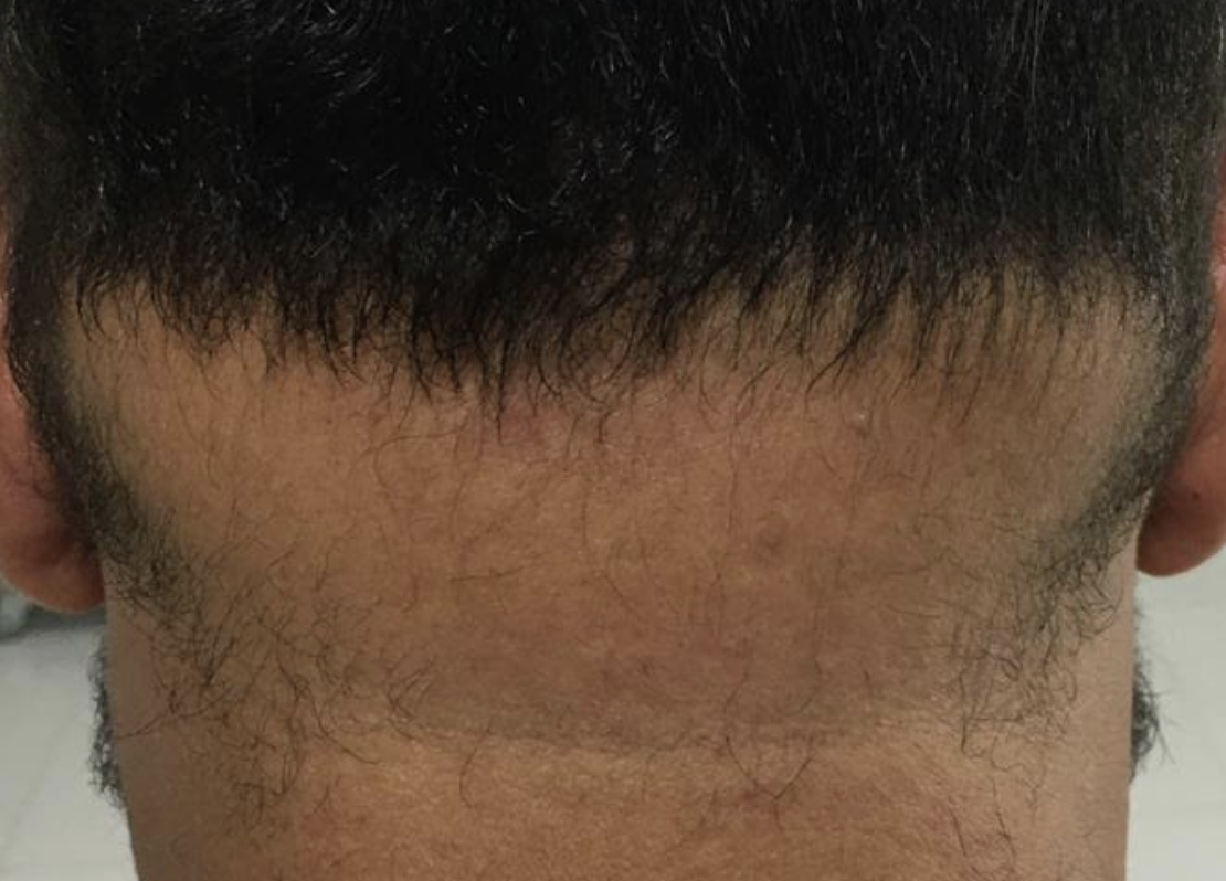 Neck hair is missing, called retrograde alopecia (photo) WRassman,M.D
