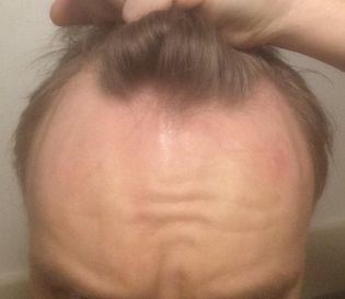 I'm 23, should I get a hair transplant? – WRassman,. BaldingBlog