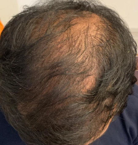 Crown thinning in a 35 year old male – WRassman,M.D. BaldingBlog