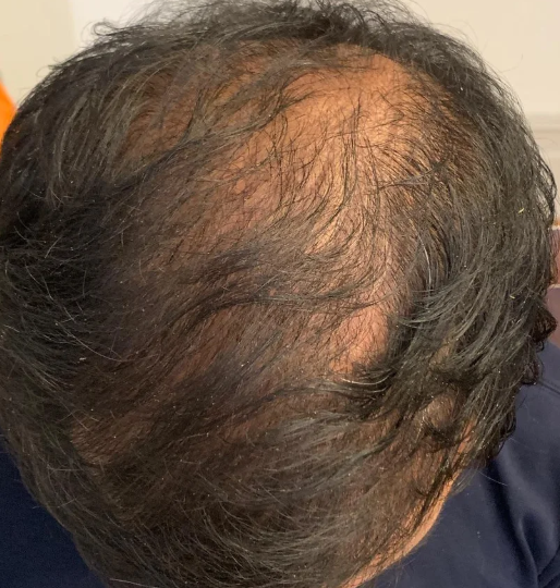 Crown thinning in a 35 year old male – WRassman,. BaldingBlog