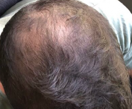 Minoxidil results in crown 3 months (photo) – WRassman,M.D. BaldingBlog