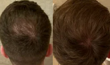  - what is metformin 500 mg used for | Something also does  finasteride regrow hair on crown seems excellent