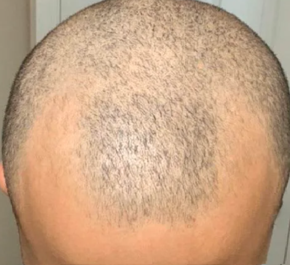 how to keep hair after stopping minoxidil