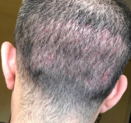 Over-harvested Donor Area From Fue – Wrassman,m.d. Baldingblog