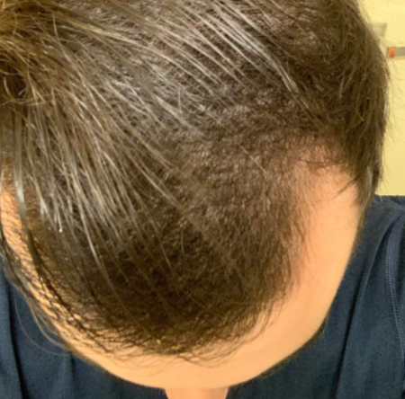 Finasteride And Minoxidil 3 Months (photo) – Wrassman,m.d. Baldingblog