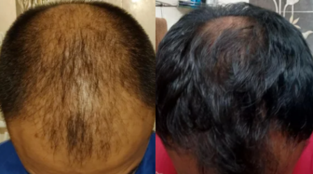 4 months on finasteride and minoxidil – WRassman,M.D. BaldingBlog