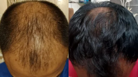 4 months on finasteride and minoxidil – WRassman,M.D.