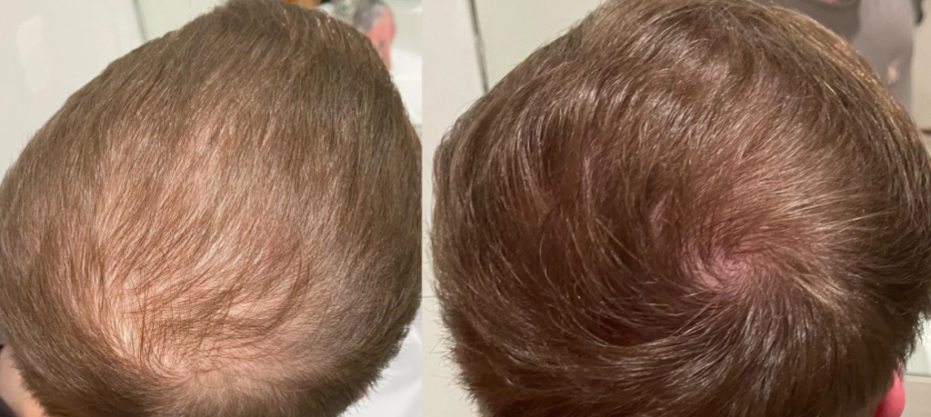 can finasteride cause hair loss