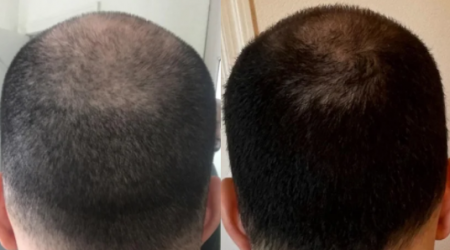 7 months on finasteride and minoxidil (photo) – WRassman,M.D. BaldingBlog