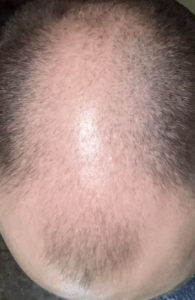 Is this scalp finasteride worthy? Would the pills fill in the gaps or is it  too late? – WRassman,. BaldingBlog