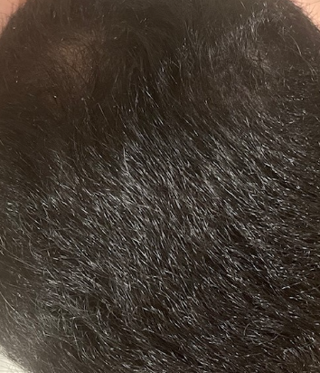 Topical minoxidil and microneedling 14 months (photo) – WRassman,M.D ...