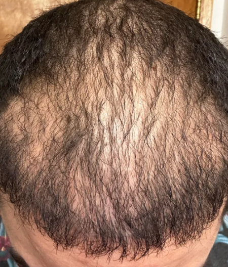 Persistent Frontal Hairline Wrassmanmd Baldingblog 2023